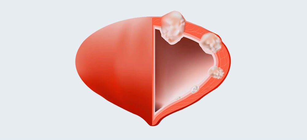 Cistectomia: a cirurgia robótica no tratamento do câncer de bexiga